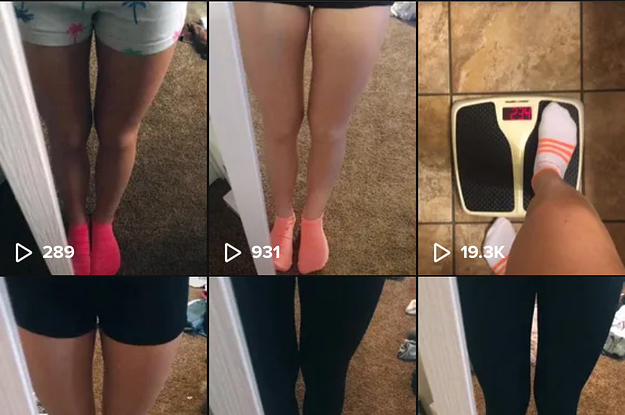 Anorexic Girls With Legs Spread Porn